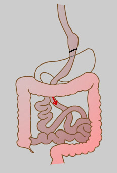 Roux-En-Y Gastric Bypass