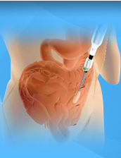 Laparoscopic Hernia Surgery