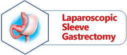 Laparoscopic Sleeve Gastrectomy