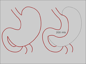 Laparoscopic Sleeve Gastrectomy